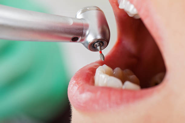 Best Emergency Root Canal Treatment in East Brooklyn, CT